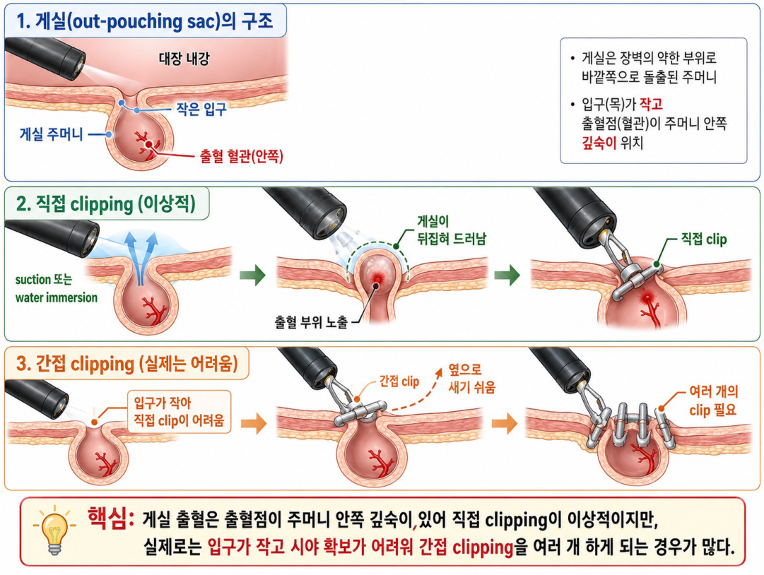 게실 clipping 모식도 — out-pouching sac 구조 및 direct vs indirect clipping(수업 손동작 GPT 요약 이미지)
