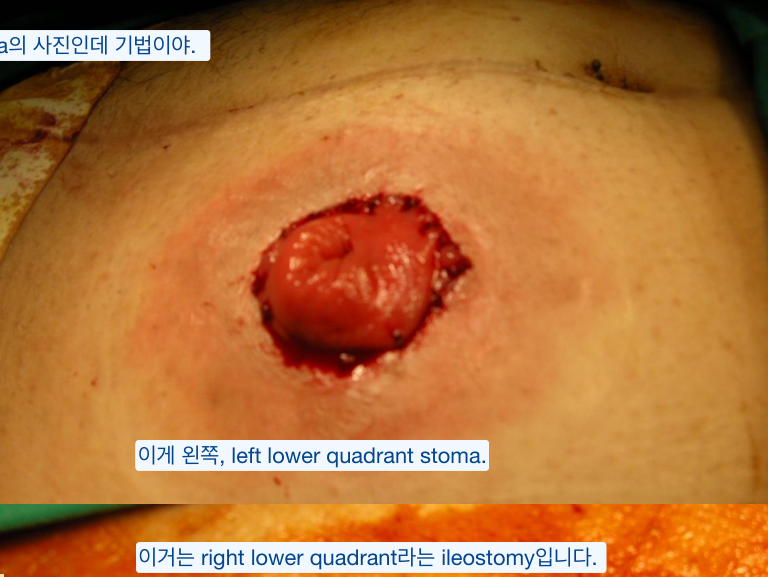 Stoma 실물 사진 — 좌하복부 colostomy·우하복부 ileostomy, rod로 고정
