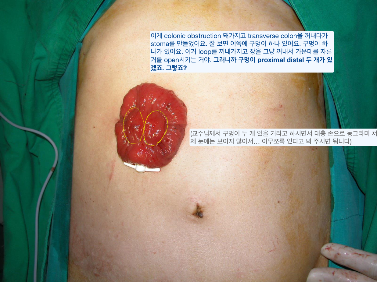 Temporary loop stoma — proximal·distal 두 개구를 가진 일시적 장루