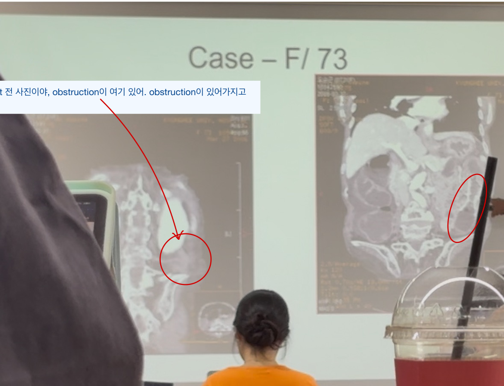Case F/73 — colonic stent 삽입 전후 영상 (폐색 → 감압)