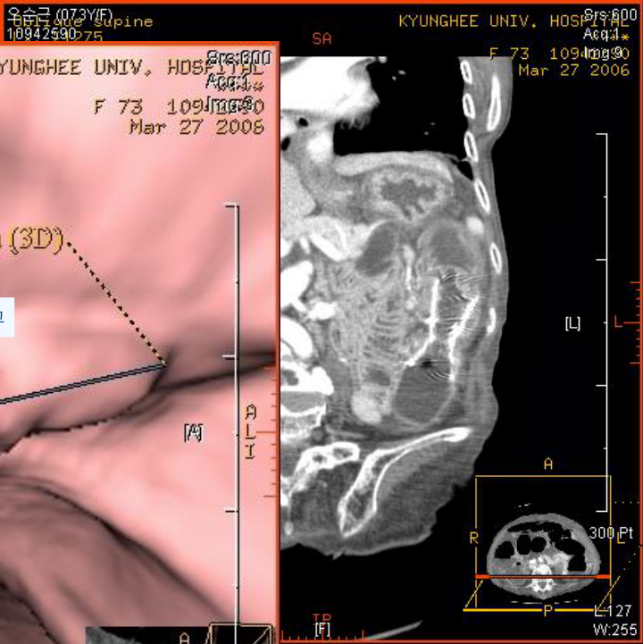 Case F/73 — 폐색부위 CT (KyungHee Univ. Hospital)