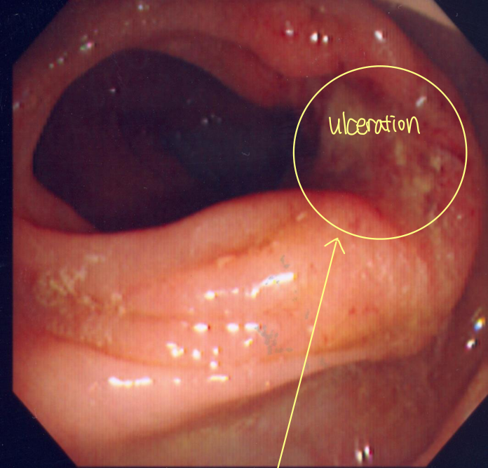Virtual colonoscopy(CT 3D 재구성) vs 실제 종양 — ulceration 동반