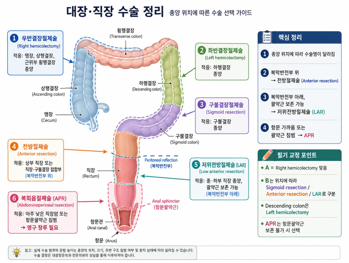 종양 위치별 수술 선택 가이드 (참고 GPT 정리도)