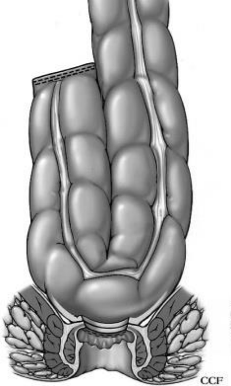 괄약근 보존술 도해 (coloanal anastomosis·J pouch)