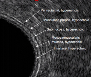 Preoperative TRUS — 직장벽 5층 + uT0N0 (점막 국한)