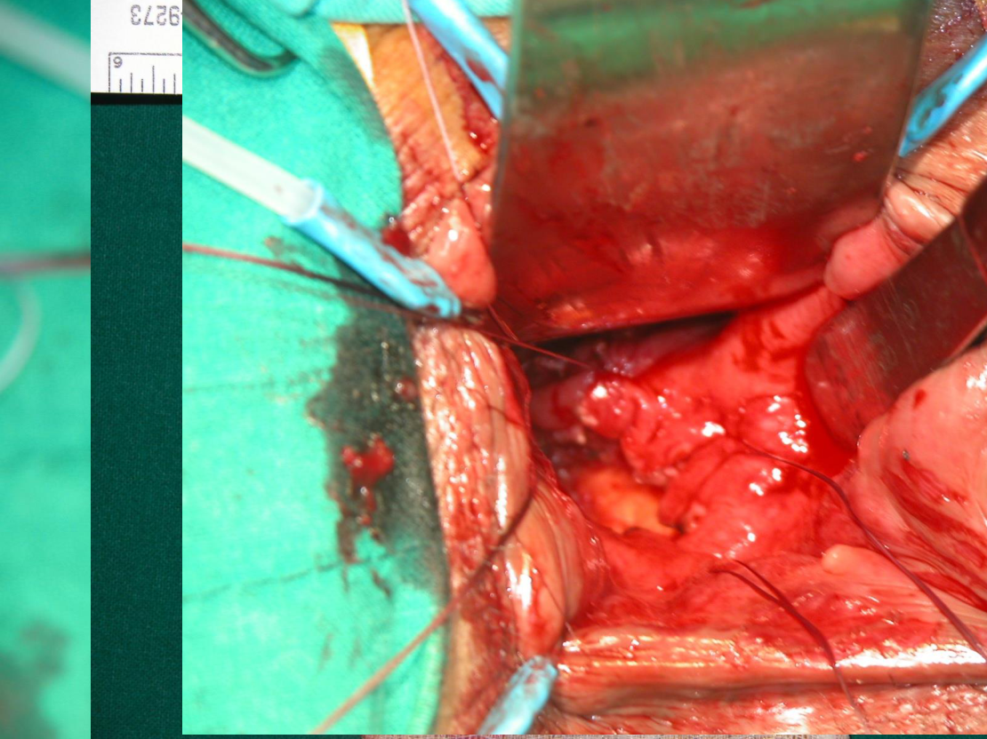 Op. Findings — 경항문 전층 절제 (perirectal fat 노출)