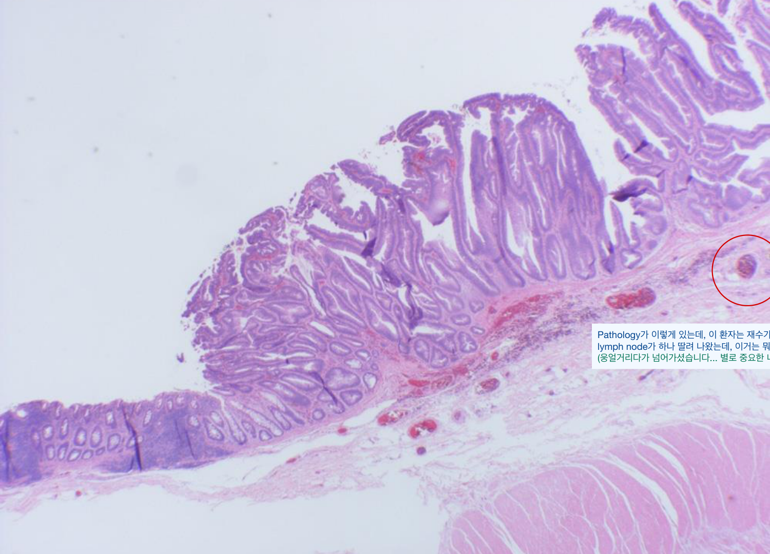 병리 조직 — lymph node 동반 (현미경)