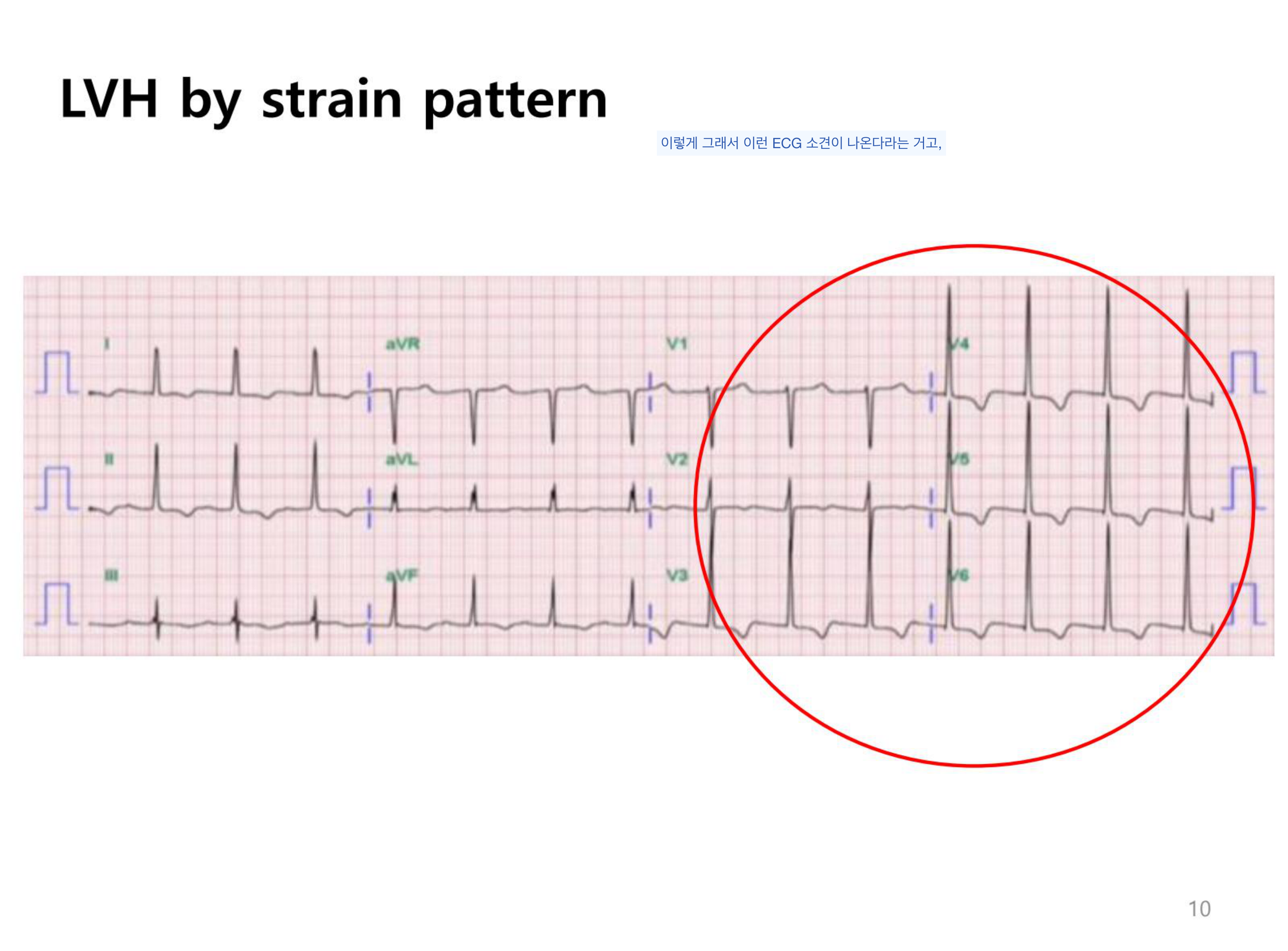 AS의 ECG — 좌측 흉부유도 LVH strain pattern(큰 R파 + ST 하강·T파 역위)