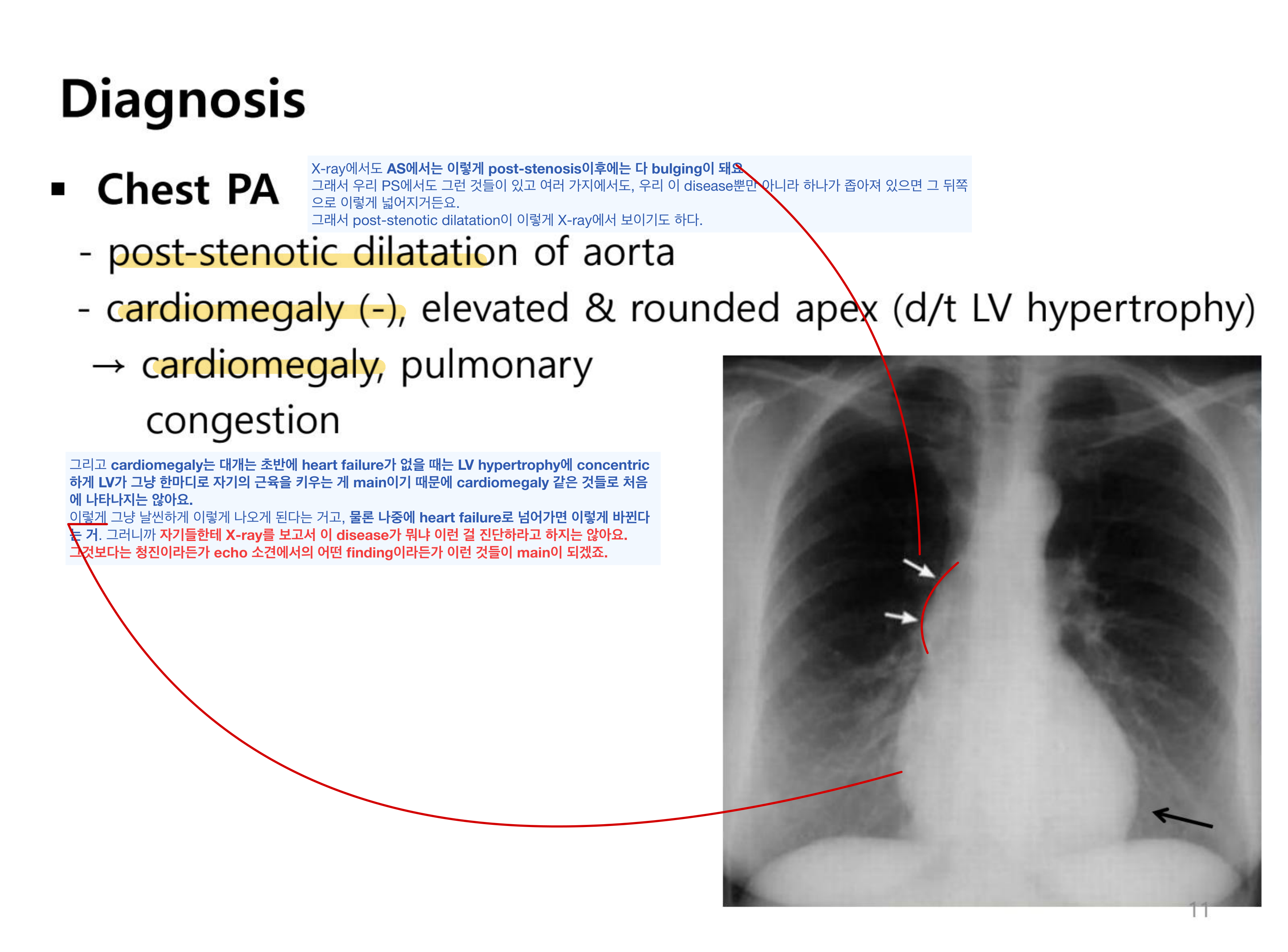 AS의 Chest PA — 상행대동맥 post-stenotic dilatation(화살표), 둥글게 들린 심첨