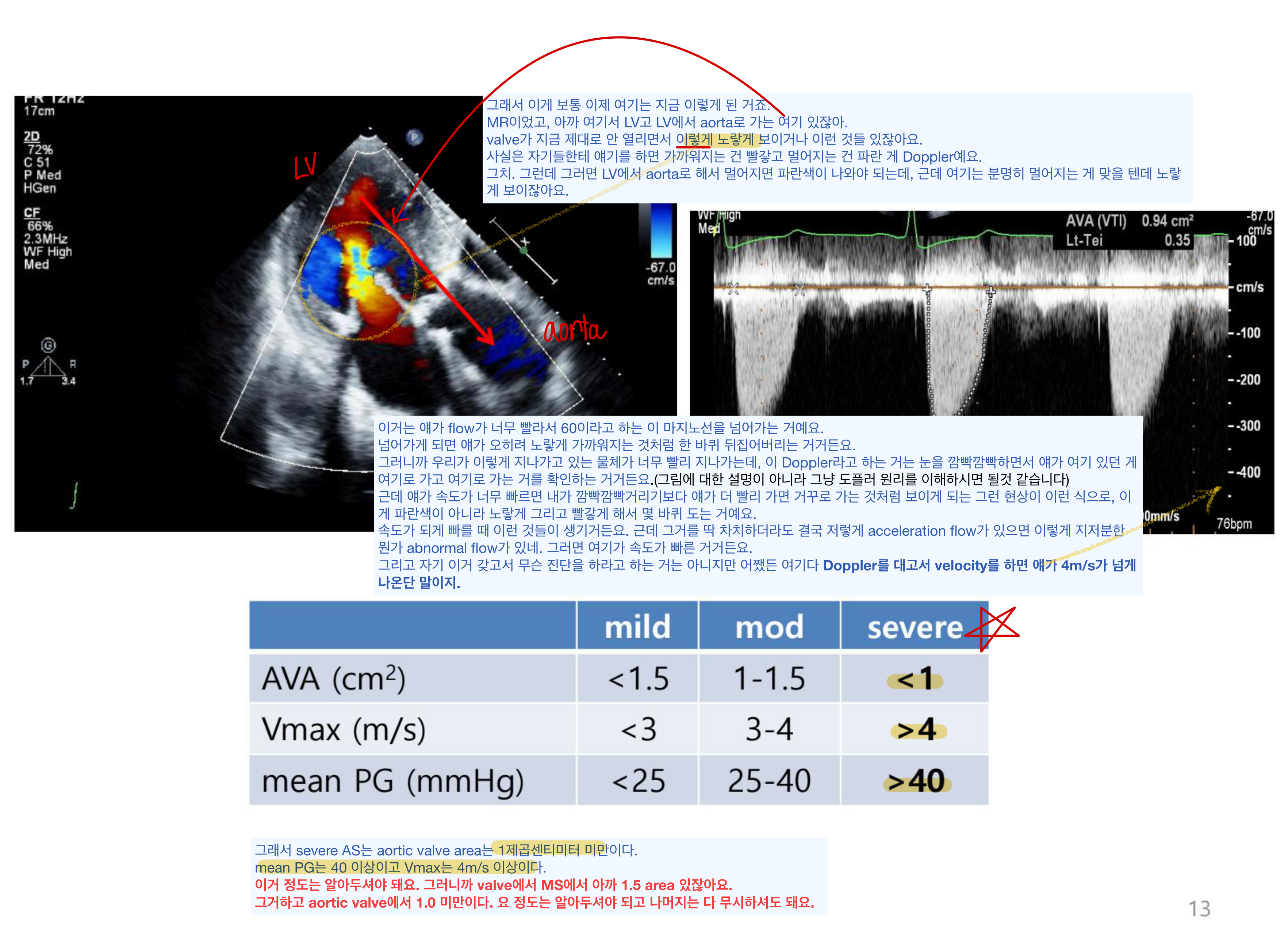 AS Doppler — color jet aliasing + CW Doppler, severity 표(AVA/Vmax/mean PG, severe 열 강조)