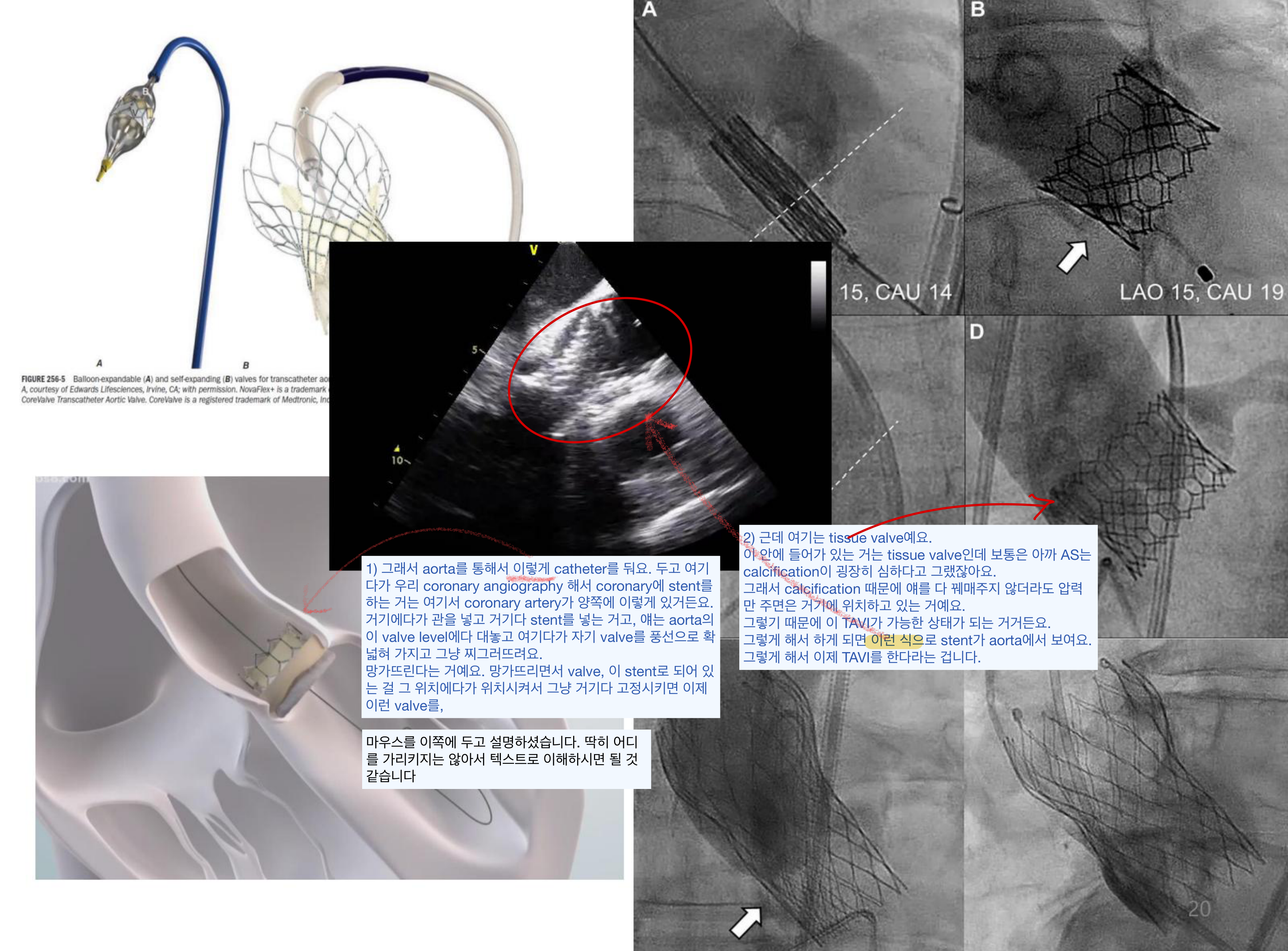 TAVR 시술 도해 — balloon/self-expanding valve 모식도 + 투시영상의 stent 거치 단계(FIGURE 256-5)