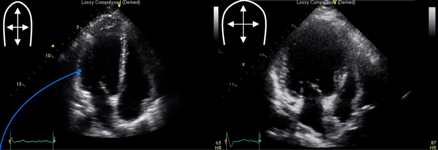 LV 형태변화 — 정상 ellipsoidal vs DCM spherical(둥근 LV)
