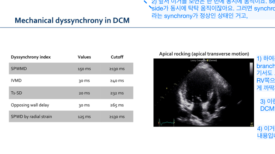 Mechanical dyssynchrony 도해 (비동기 vs 동기 수축)