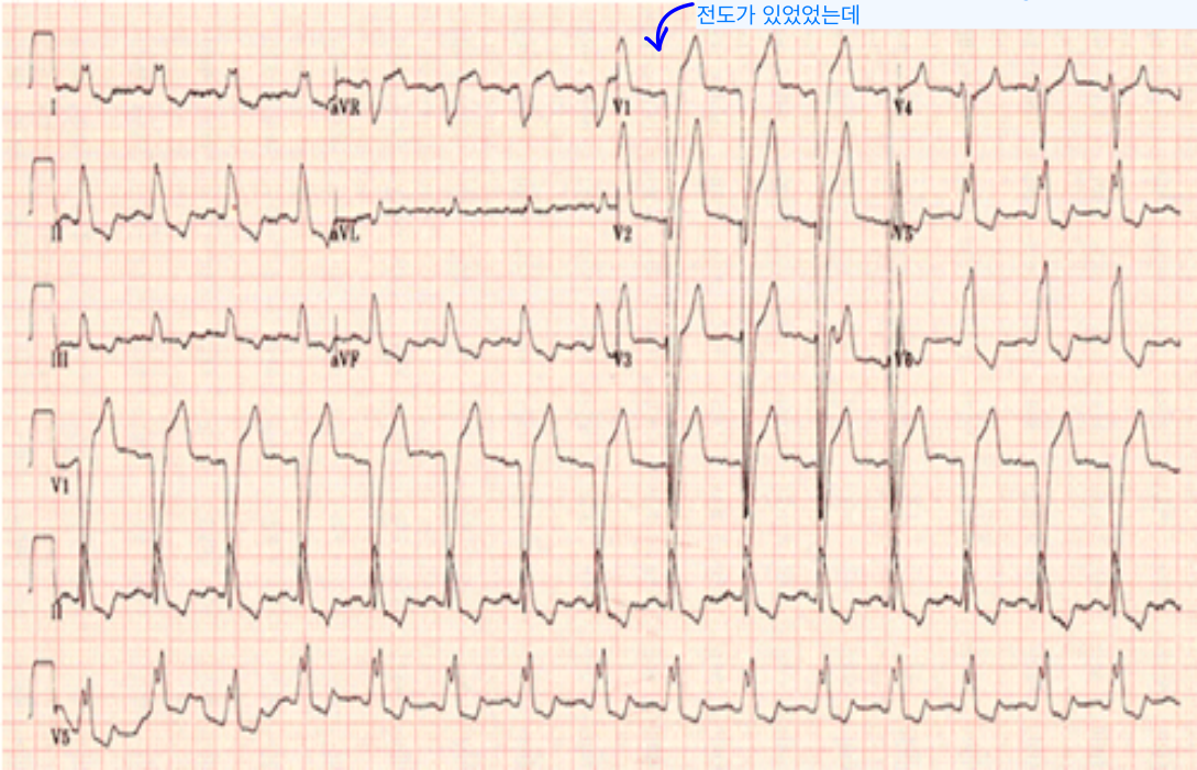 Pre-CRT — NYHA III 환자의 흉부 X-ray + LBBB(wide QRS) 심전도