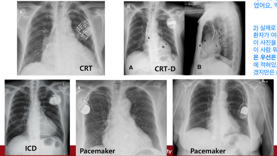 장치 lead 비교 X-ray — ICD/Pacemaker/CRT/CRT-D