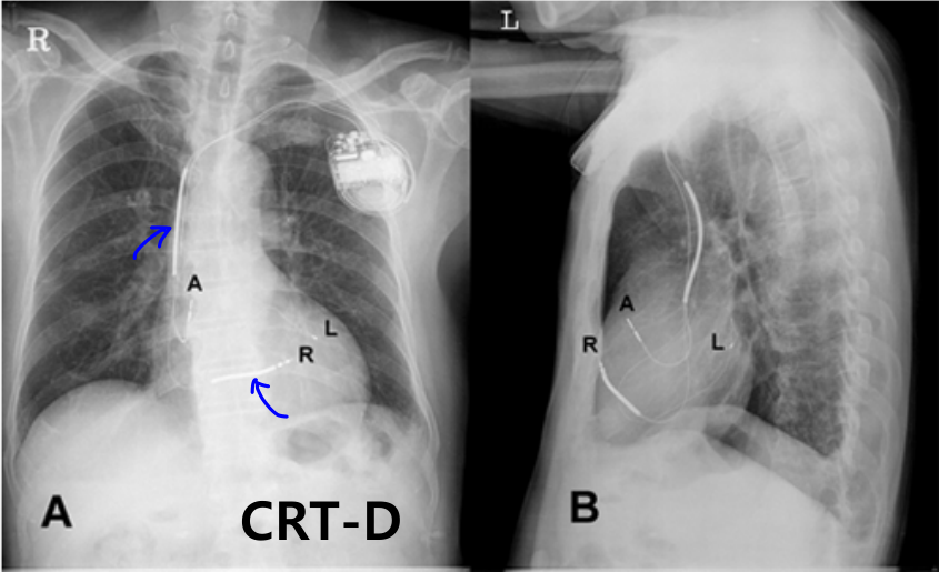 장치 종류 X-ray 비교 — CRT/CRT-D/ICD/Pacemaker