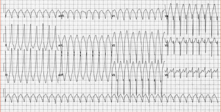 ARVC — epsilon wave 심전도 + RV fibrofatty replacement