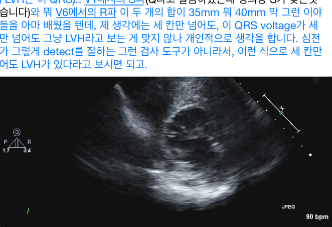HCM 심초음파(두꺼운 심벽) + LVH strain pattern 심전도