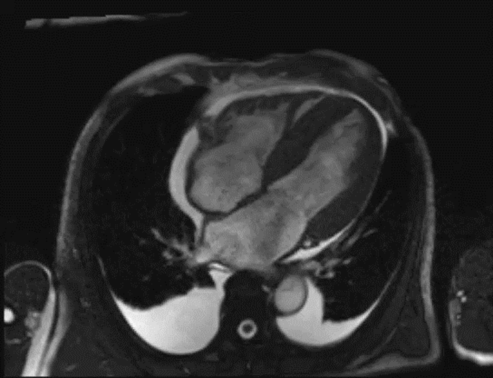 HCM cine MRI — 두꺼워진 심근의 형태·기능