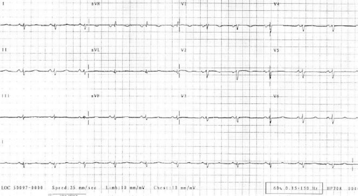 RCM 심전도 — low QRS voltage