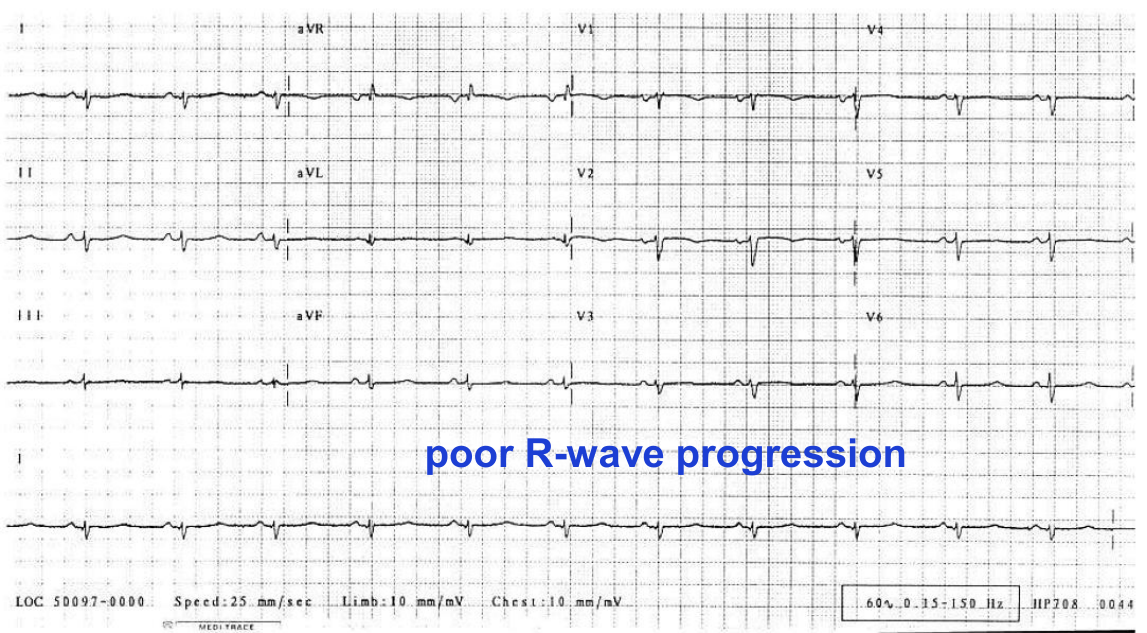 Cardiac amyloidosis 사례 ECG — low voltage·poor R progression