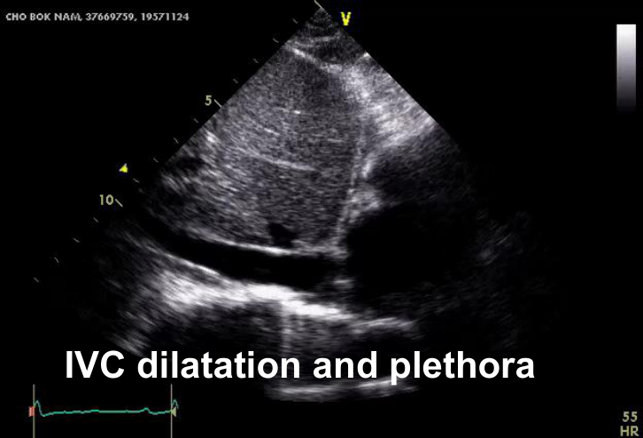 Cardiac amyloidosis echo — granular sparkling·벽두께↑·심방확대·effusion