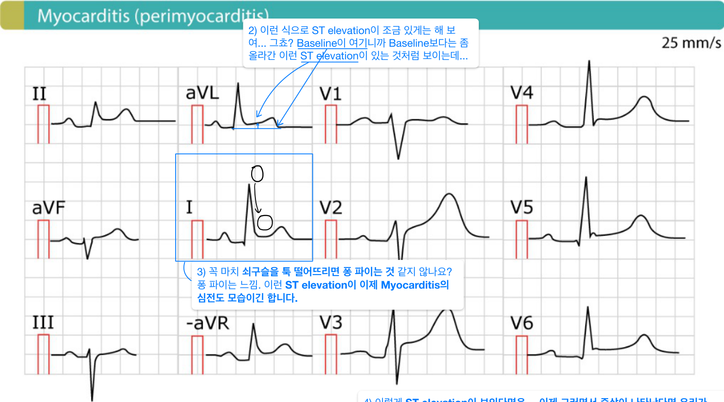 심근염(perimyocarditis) ECG — 미만성 concave ST elevation