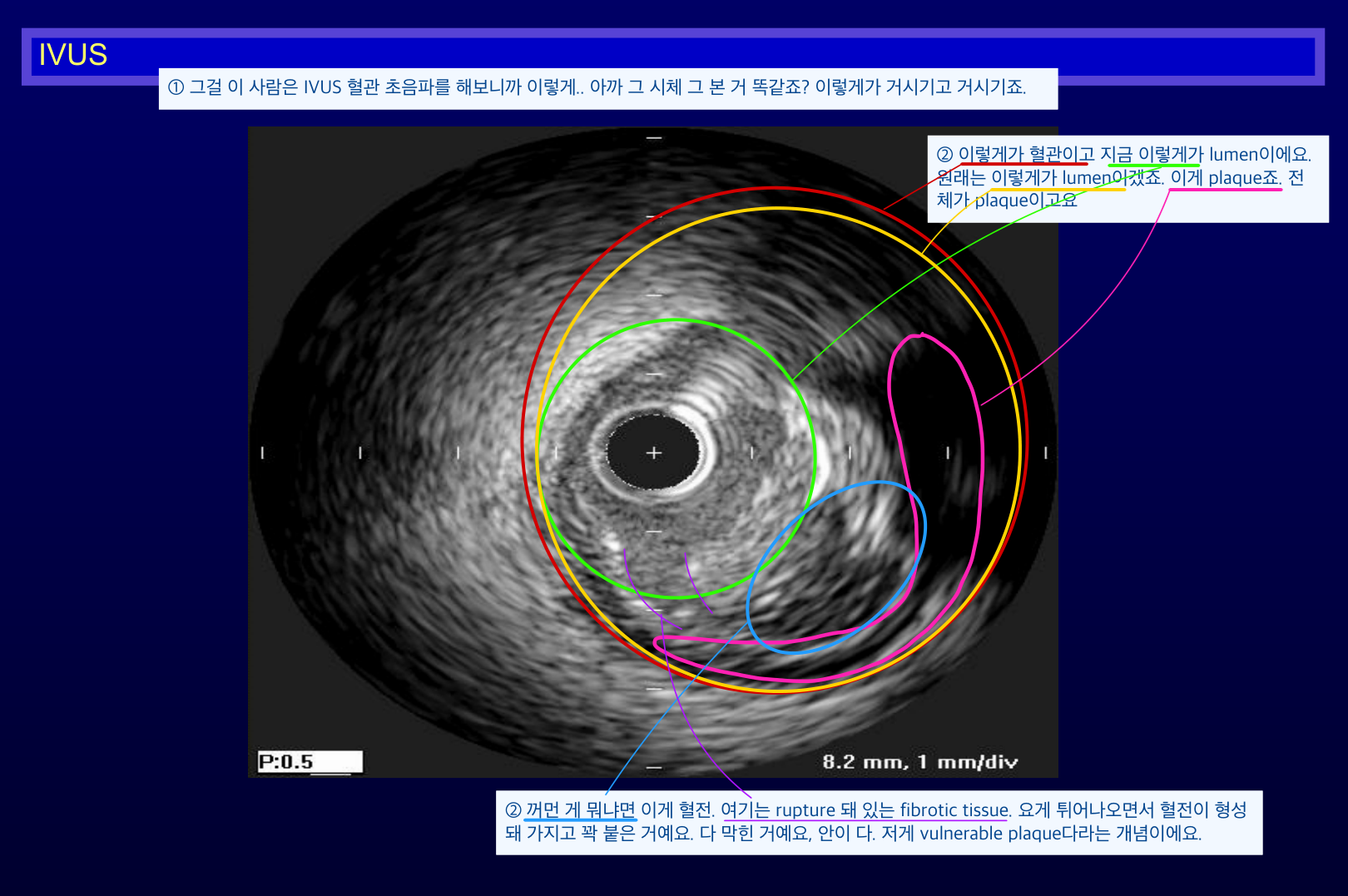 IVUS — 파열된 fibrous cap과 혈전으로 폐쇄된 lumen(vulnerable plaque).