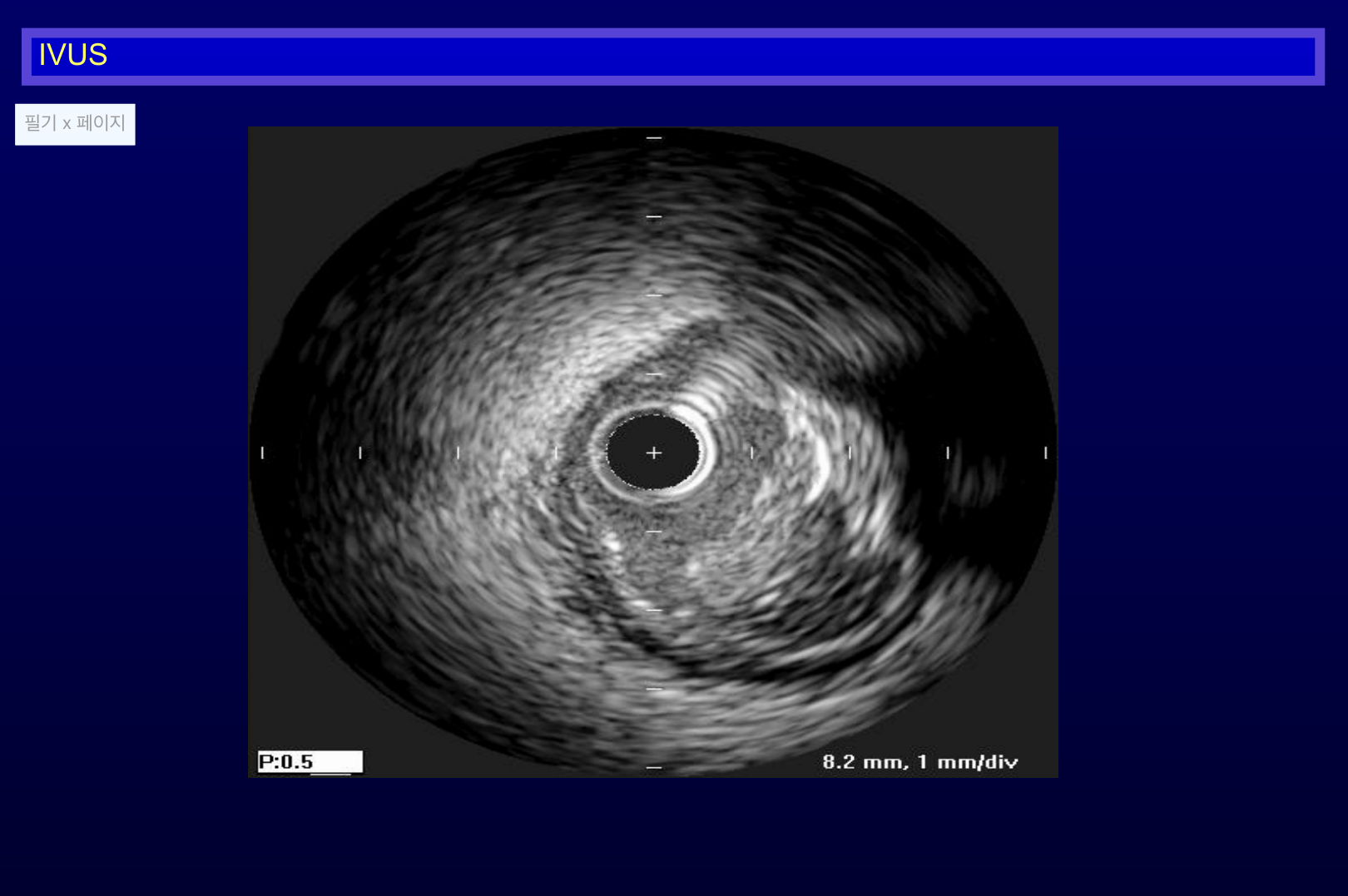 IVUS 소견 도해.