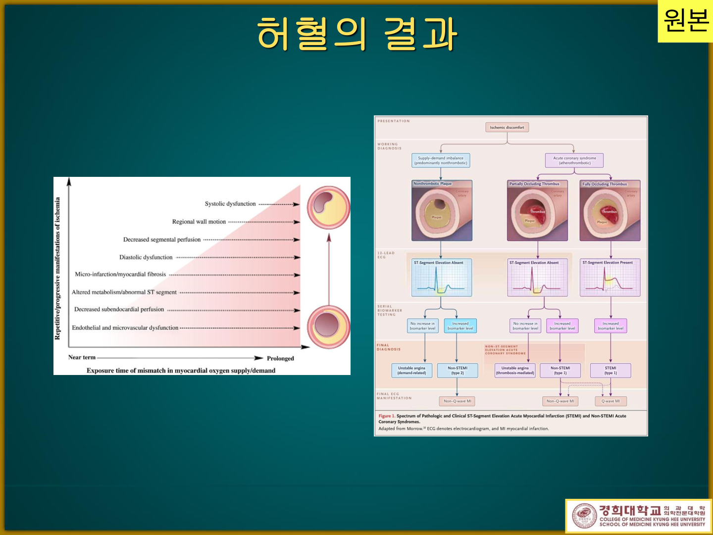 Ischemic cascade — 노출시간에 따른 허혈 기능이상 순서(내피기능이상→systolic dysfunction)