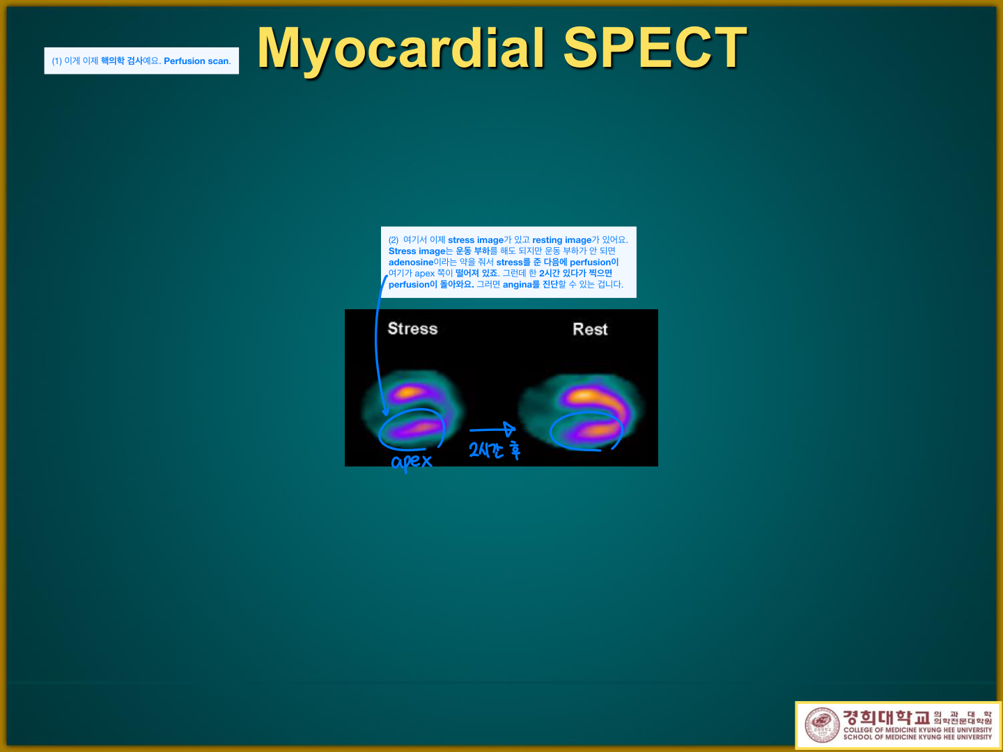 Myocardial perfusion SPECT — stress vs rest image (reversible perfusion defect)