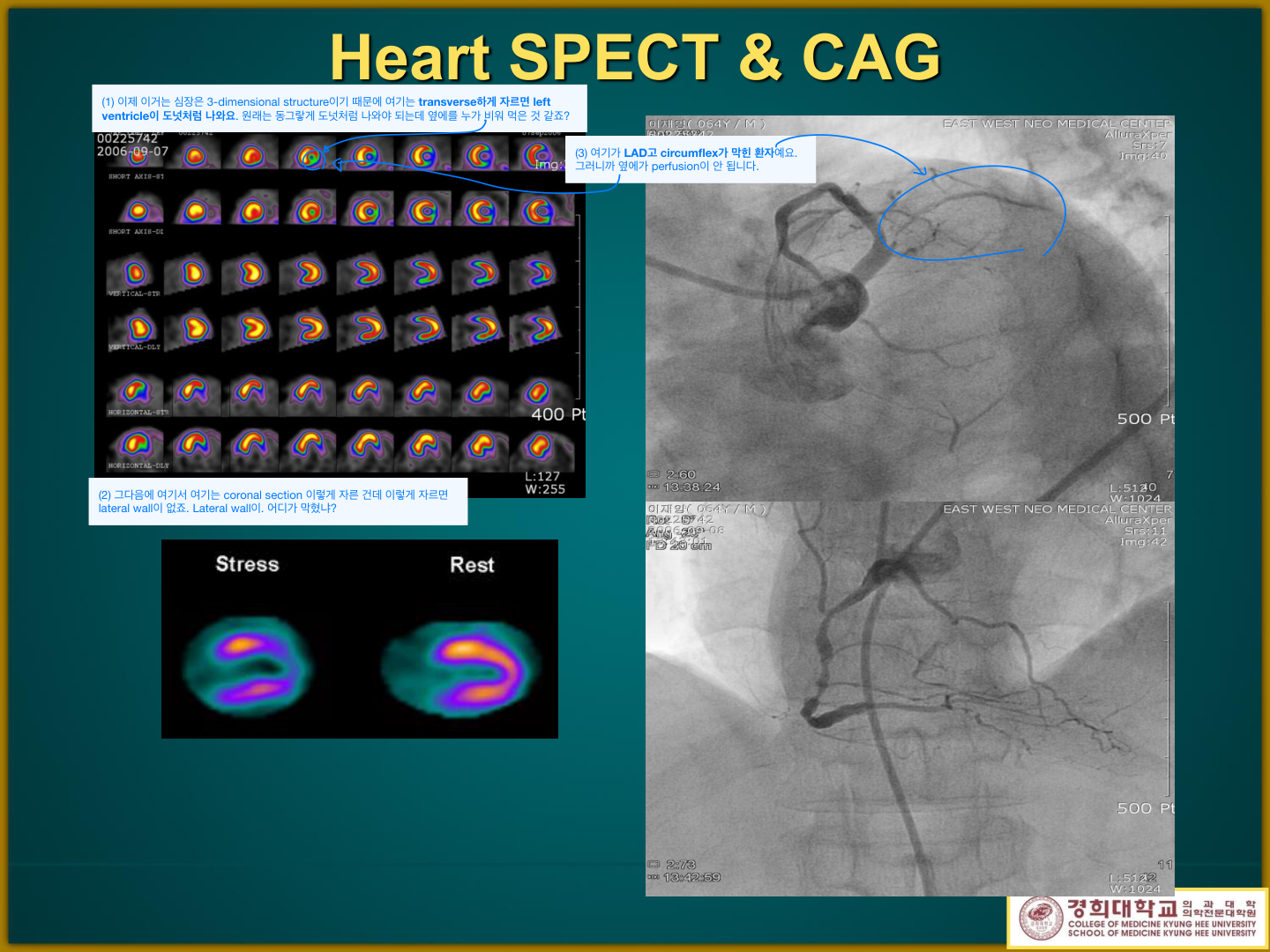 심근 SPECT 단면(short/vertical/horizontal axis)과 관상동맥조영술 비교 — perfusion 결손 부위