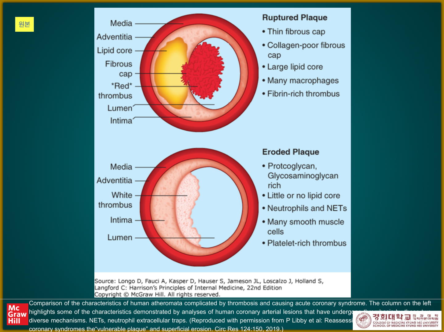 Harrison/Libby — ruptured plaque vs eroded plaque의 thrombus 기전(NETs 포함)