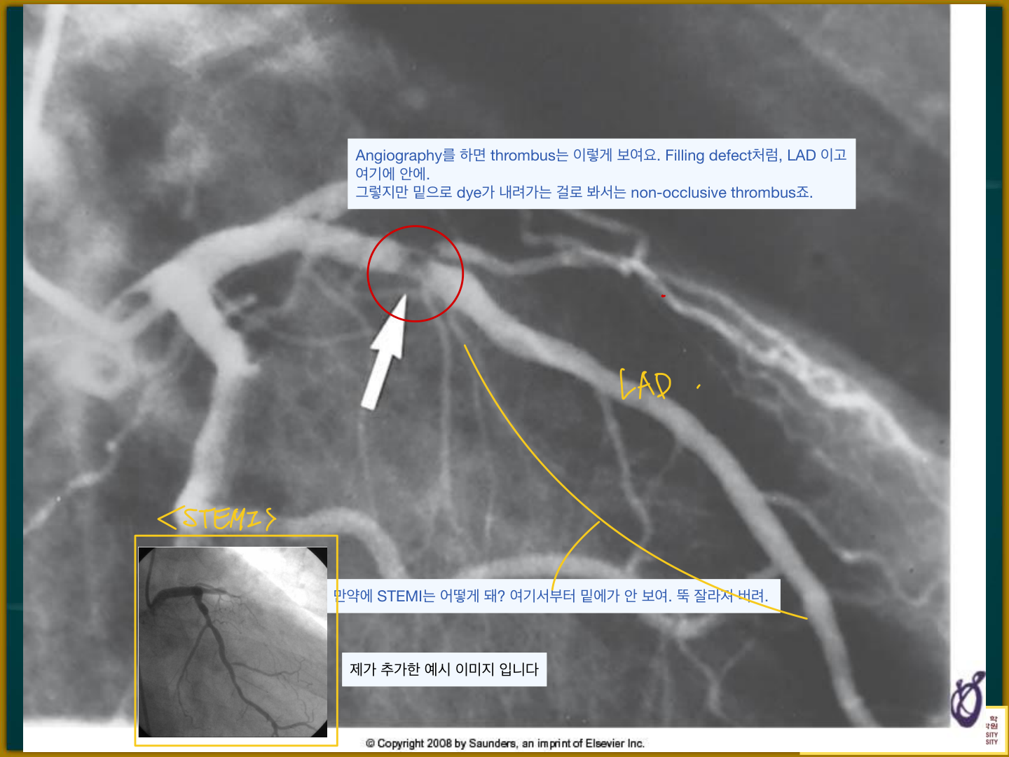 관상동맥조영술 — LAD의 non-occlusive thrombus(filling defect, 교수 추가 예시)
