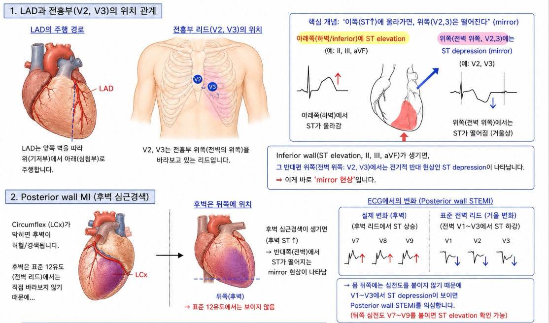 LAD 주행과 전벽 유도(V2,V3) 위치 관계 — 하벽 ST상승의 reciprocal(mirror) ST하강 개념(AI 보조 도해)