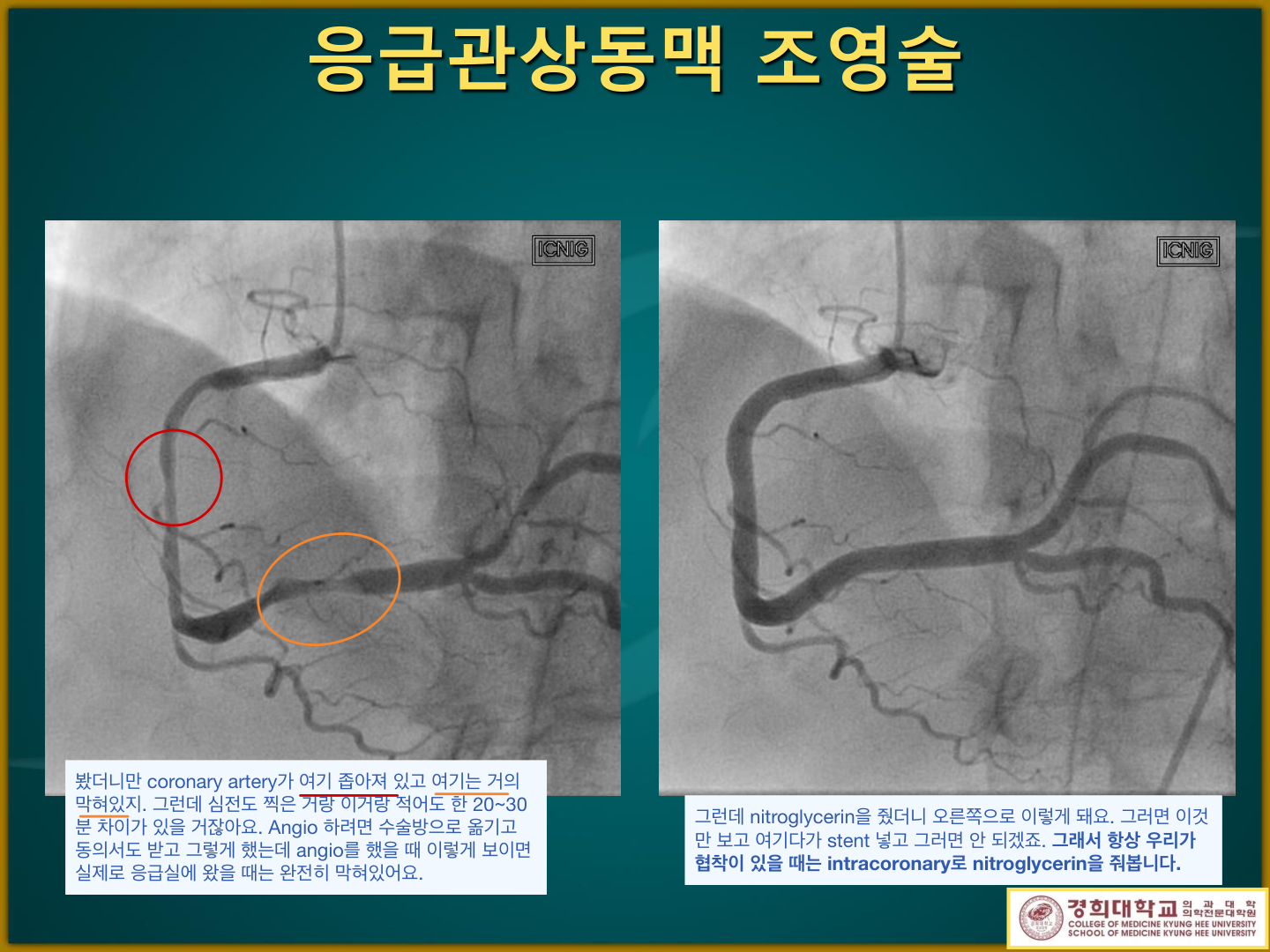 응급 관상동맥조영술 — IC nitroglycerin 전(연축 협착) vs 후(풀림)
