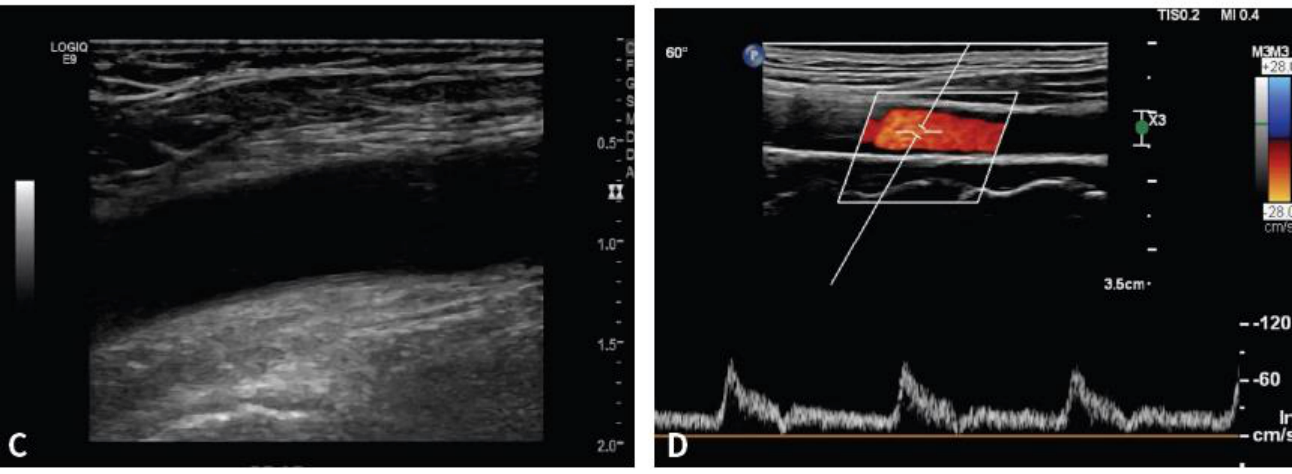 대퇴동맥 B-mode와 pulsed-wave doppler duplex 영상.