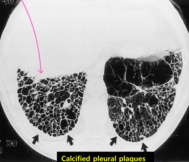 석면폐증 — calcified pleural plaques·하부 선상음영