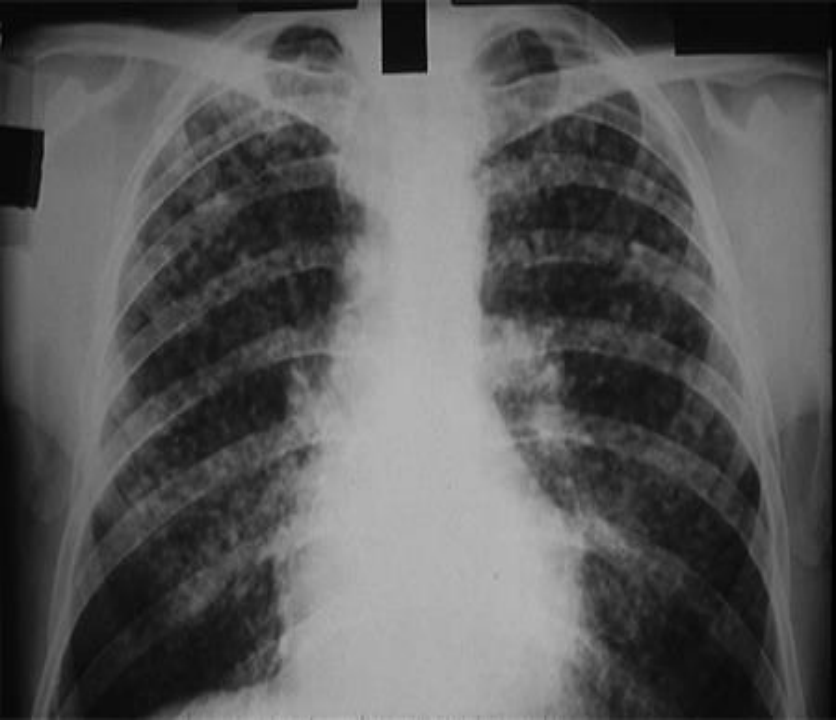 Simple coal worker's pneumoconiosis — 흉부 X선