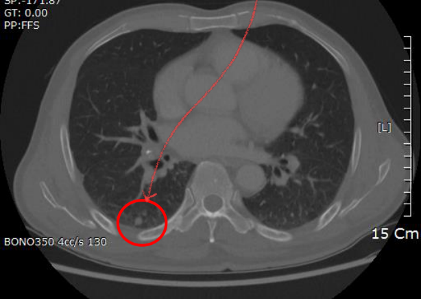 Chest CT — 양폐 다발성 well-defined nodule