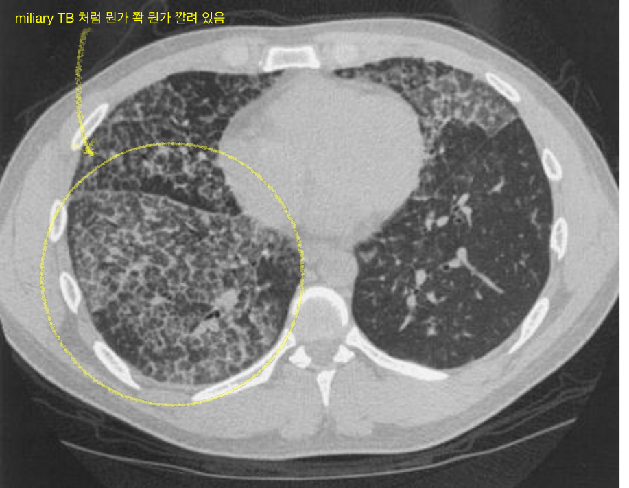 Acute silicosis — crazy paving 흉부 CT
