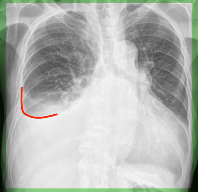 흉수 chest PA — 우측 CPA blunting과 meniscus sign(상연이 오목한 음영)을 보이는 흉수 영상.