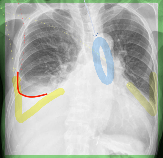 동일 흉수 chest PA 슬라이드 — 우측 CPA blunting/meniscus sign 판독 설명.