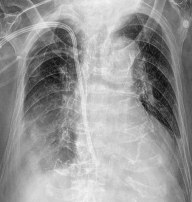 흉수 chest AP — 우측 폐음영의 전반적 증가, 횡격막 윤곽 소실.