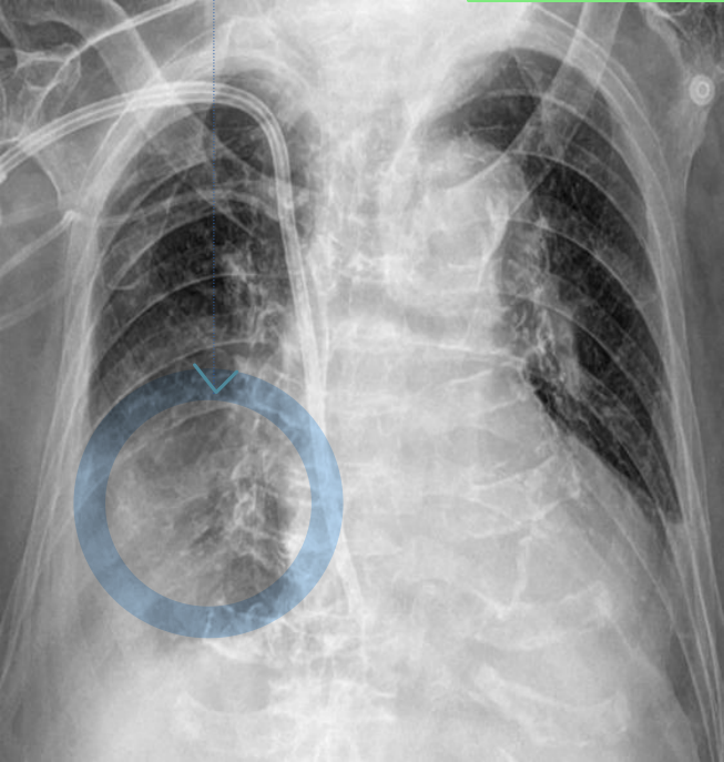 동일 흉수 chest AP — 횡격막 윤곽 소실 판독.