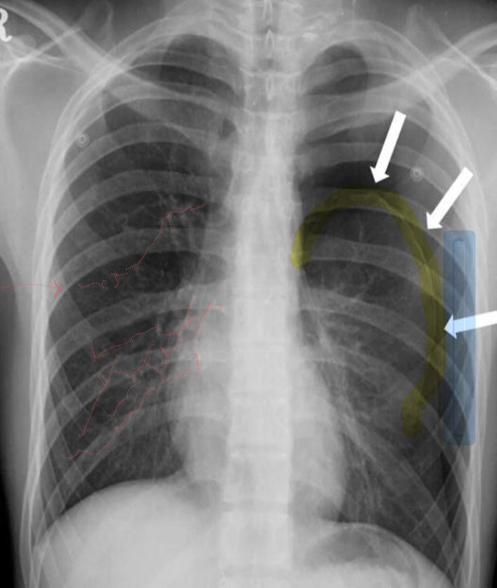 좌측 기흉 chest PA — chest wall과 평행한 pleural line, 그 바깥쪽 lung marking 소실.