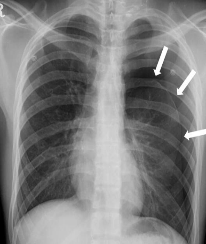 기흉 chest PA 원본 영상 — pleural line, lung marking 소실.