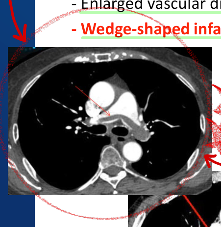 조영증강 흉부 CT(main PA level) — 폐동맥 내 intraluminal filling defect와 wedge-shaped infarction을 보여주는 Acute PE 대표 영상.