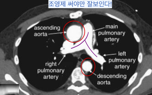 Main PA 분지부 조영증강 CT — 하얀 조영 속 진한 intraluminal filling defect(acute angle)가 보이는 Acute PE.
