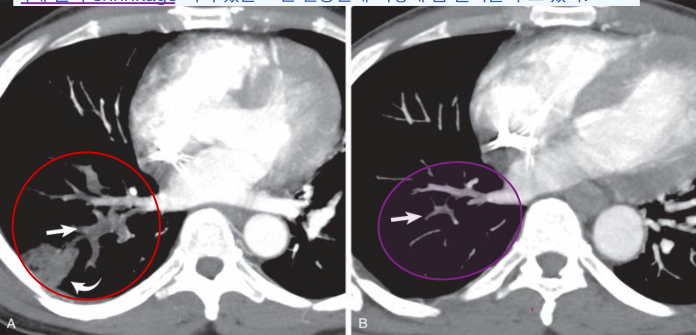 Chronic PE CT — 벽에 둔각으로 납작하게 붙은 eccentric filling defect와 mosaic attenuation.